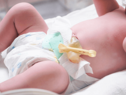 Recém-nascido com clip no coto umbilical Cuidados com Cordão Umbilical
